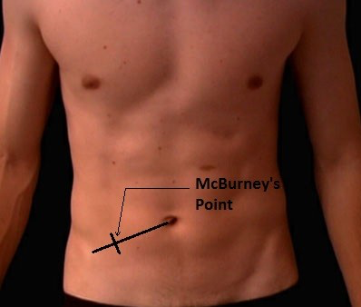 Picture of man's abdomen, x where McBurney's point is.